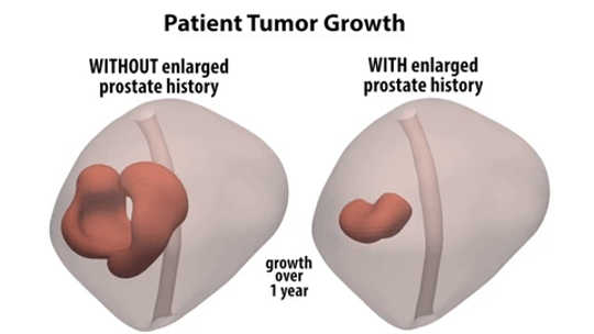 Do Enlarged Prostates Actually Protect Against Tumors?