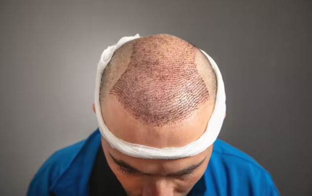 A doctor performing hair transplant surgery, showing precision in handling grafts to ensure minimal risk and optimal recovery.