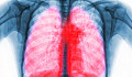 An illustration of immune cells interacting with lung tissue, representing the role of immune cells in long COVID lung scarring and potential treatment strategies.