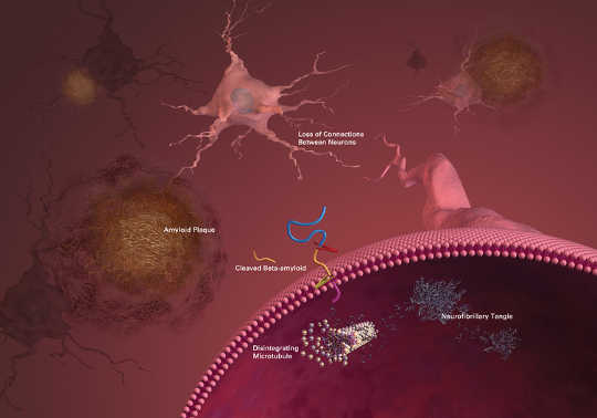 Tangles and plaques characteristic of Alzheimer’s disease are the target of most treatments in development. NIH Image Gallery/Flickr, CC BY