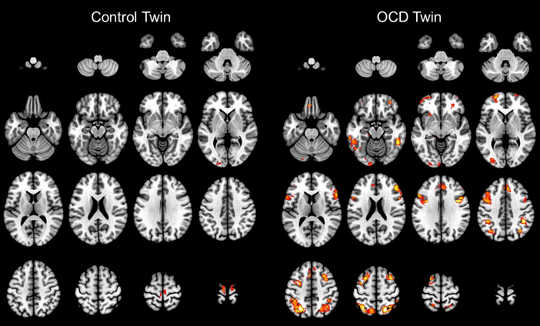 Seeing The Actual Problem In The Brain Decreases The Stigma Of Illness