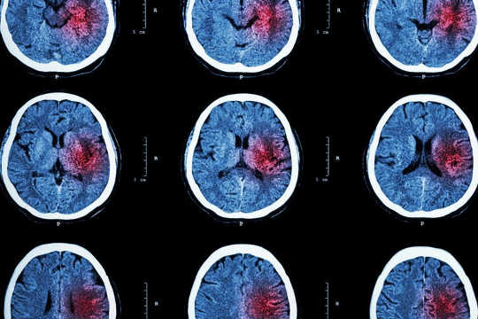 A Mediterranean Diet Reduces The Stroke Risk In Women