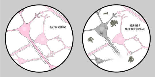 The Pathology of Alzheimer’s Disease