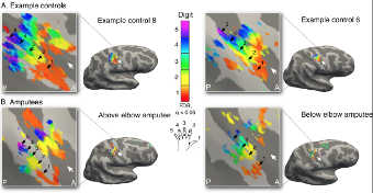 How The Brain Remembers Amputated Limbs And Continues To Control Them