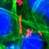 Listeria inside pancreatic tumor.